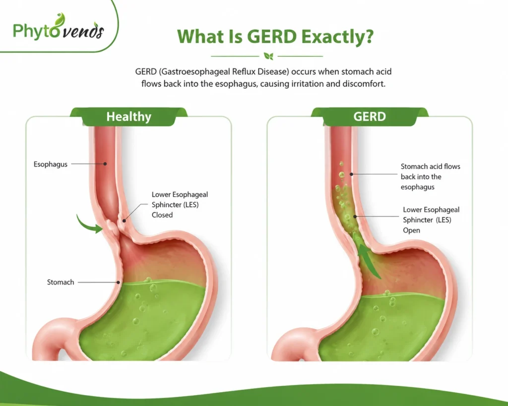 What is GERD (gastroesophageal reflux disease) - Phytovends